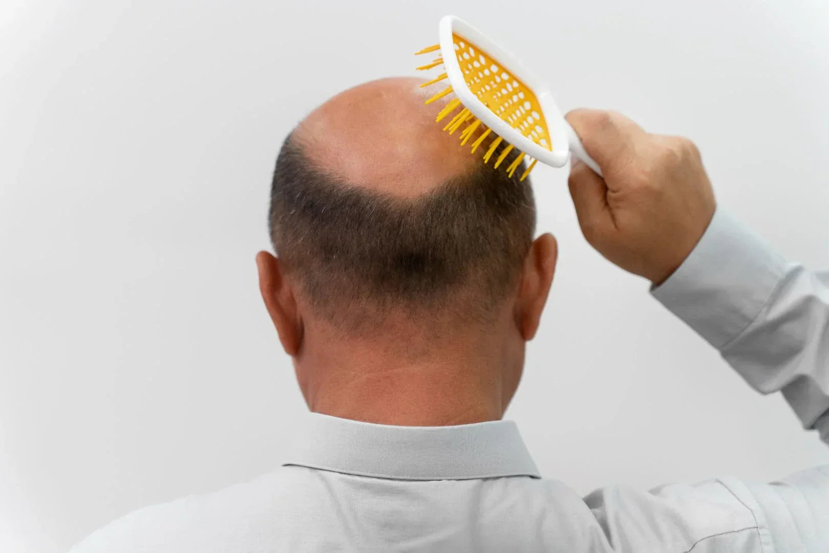 Treatment of Hereditary Baldness